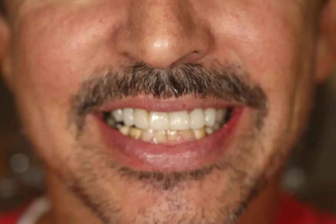 clean healthy gums and teeth after holistic smile treatment