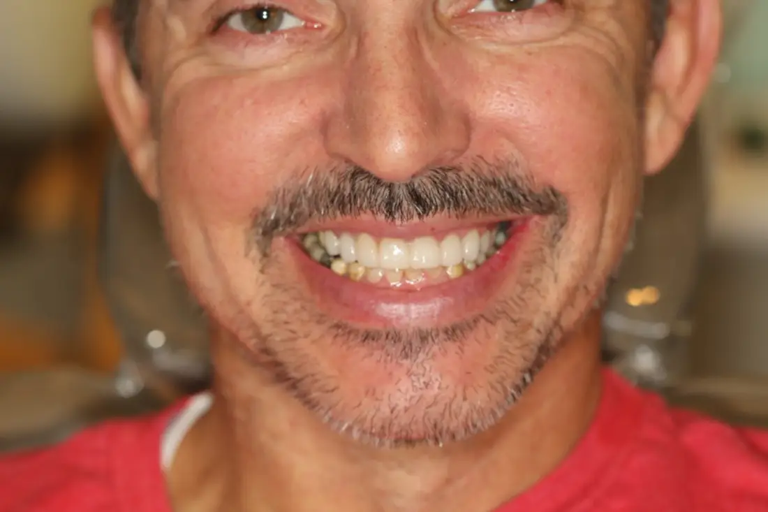 unhealthy gum lines and teeth staining before treatment