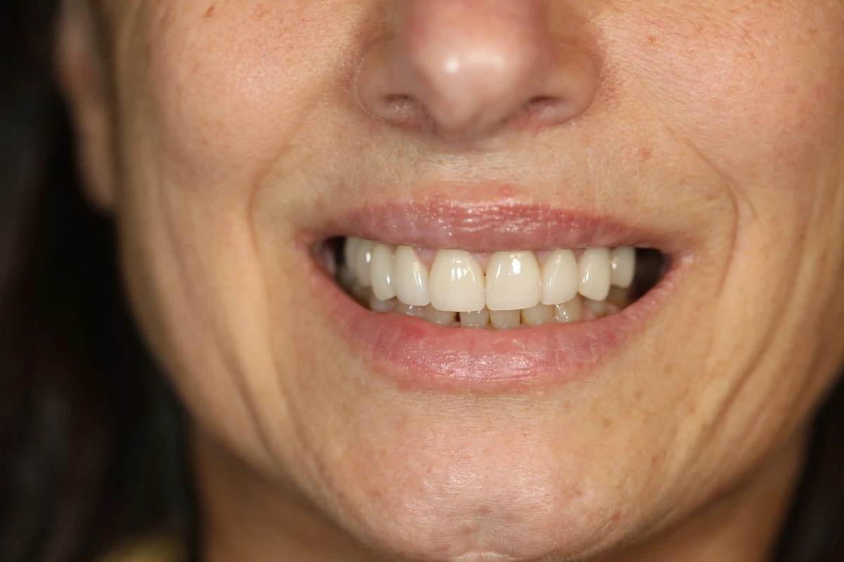 A natural makeover in progress after