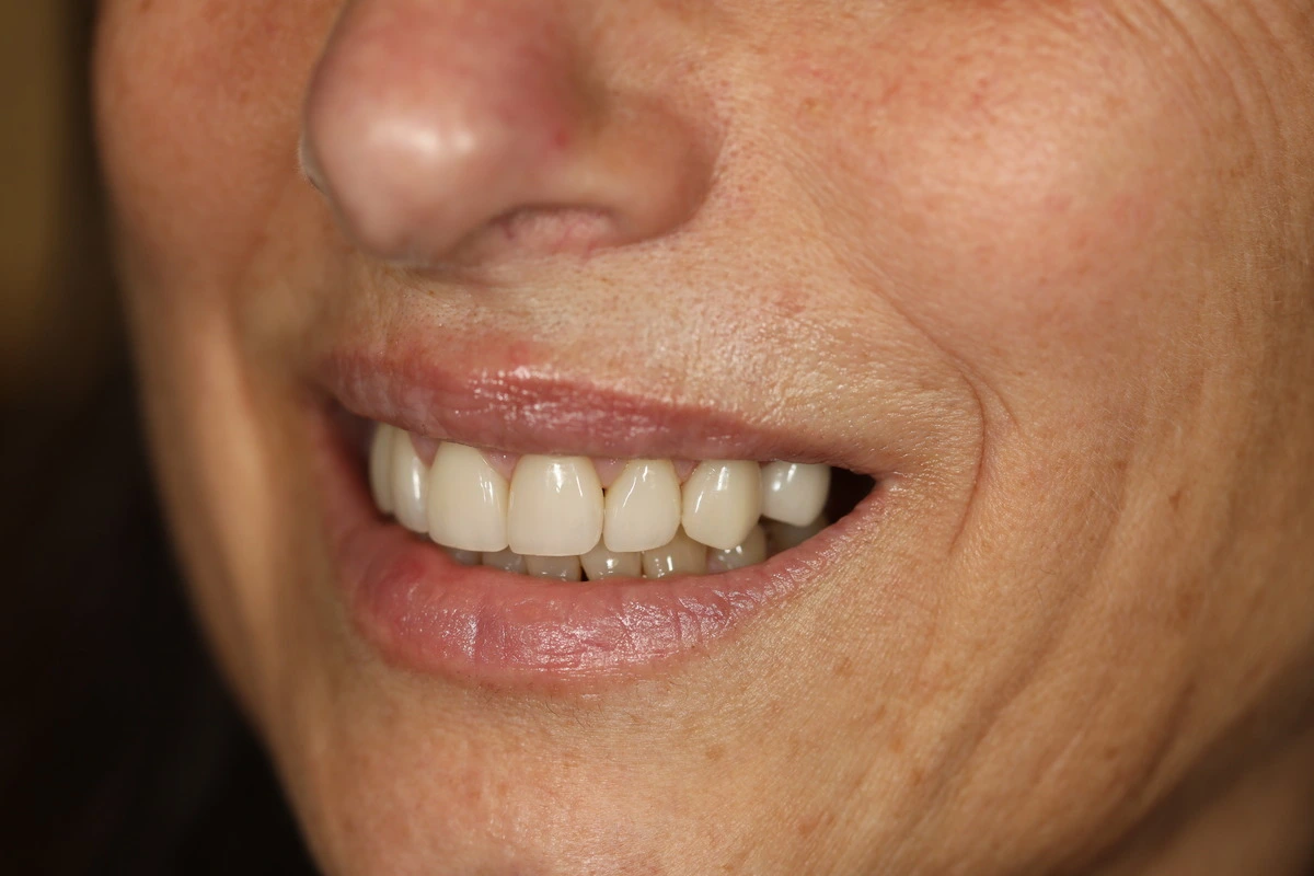 A natural makeover in progress before