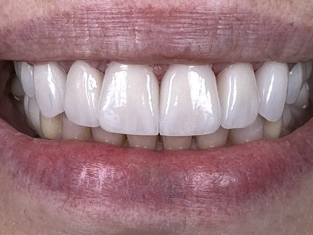 a new smile with veneers after