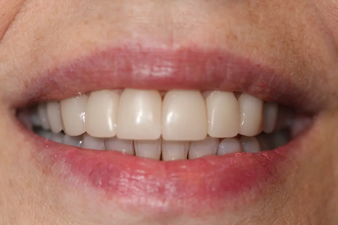 a new smile with veneers before