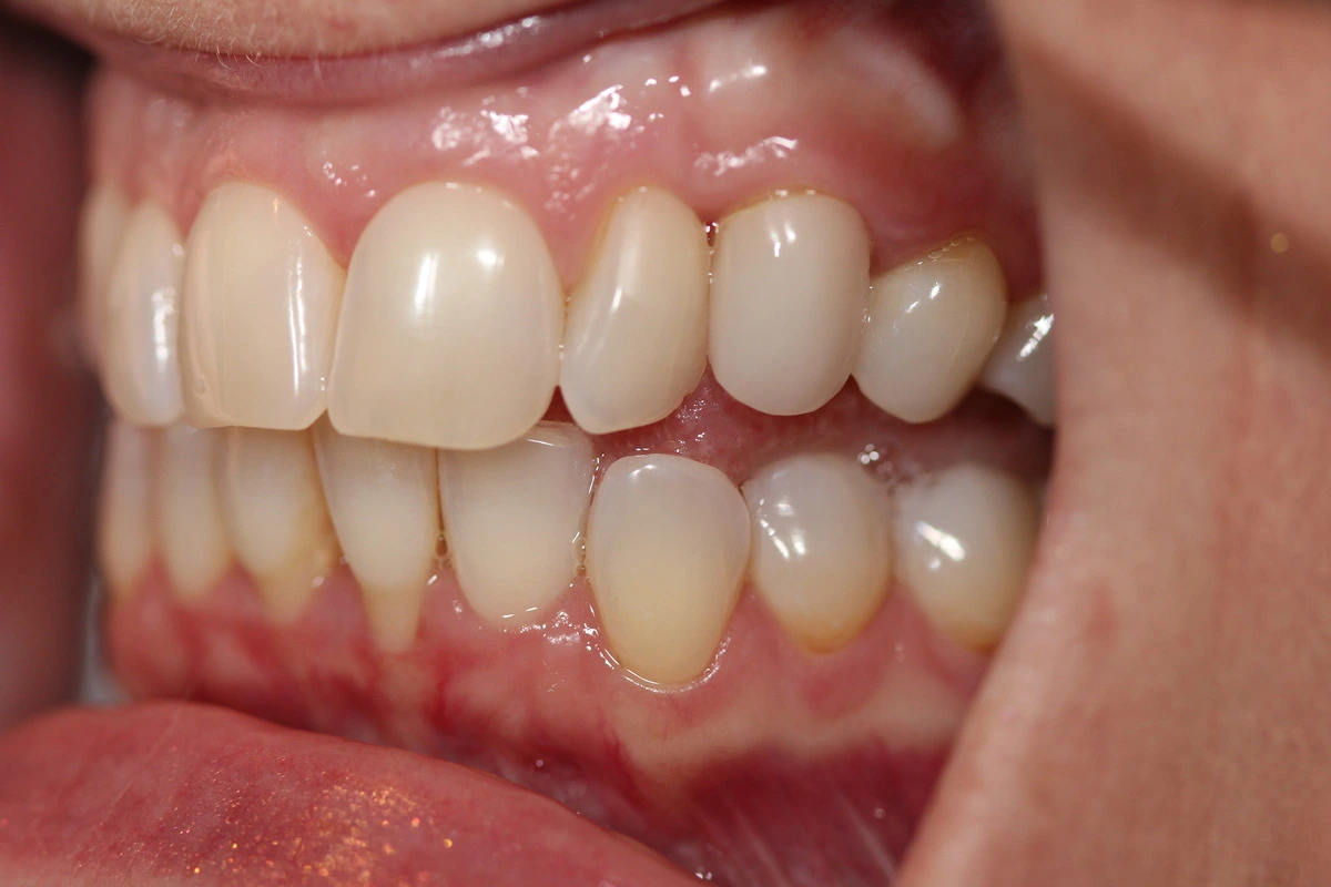 baby tooth transformation after
