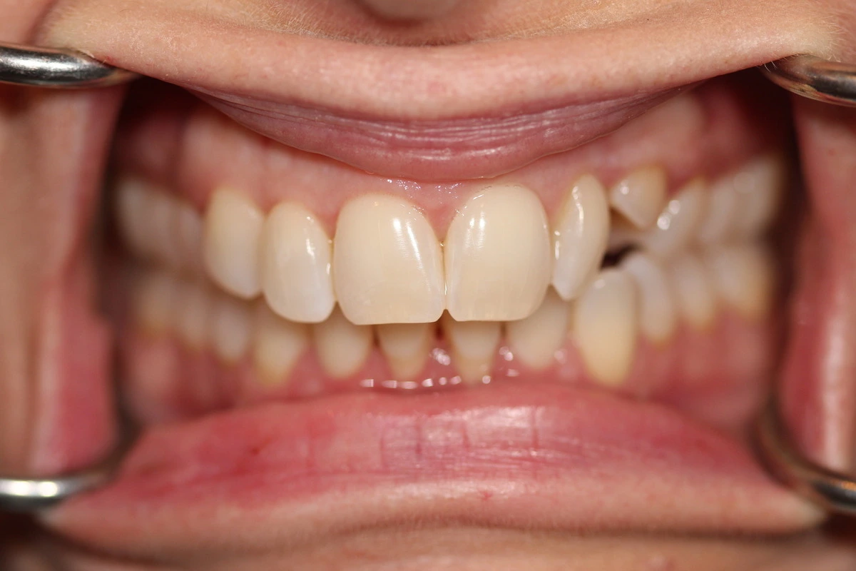 baby tooth transformation before