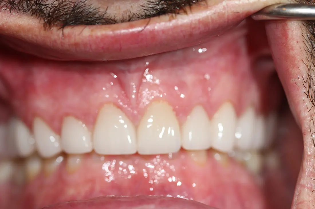 beautiful smile restoration after