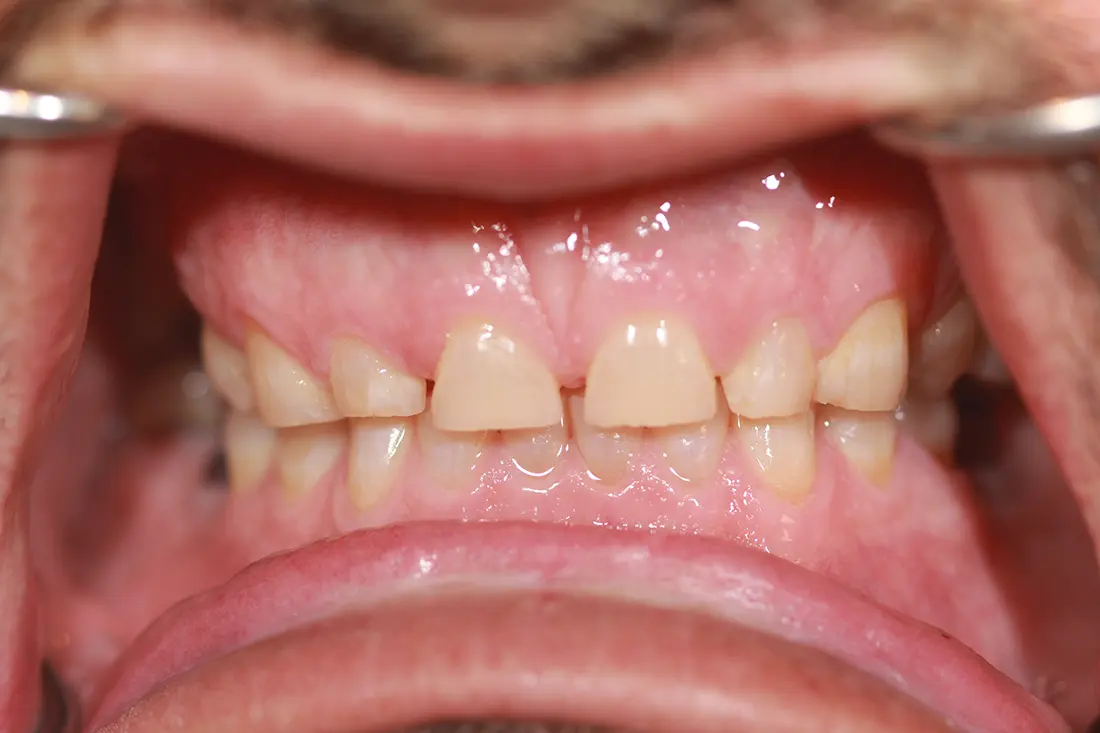beautiful smile restoration before