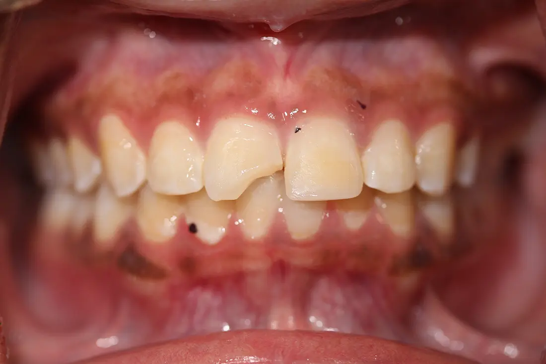 broken tooth restoration before