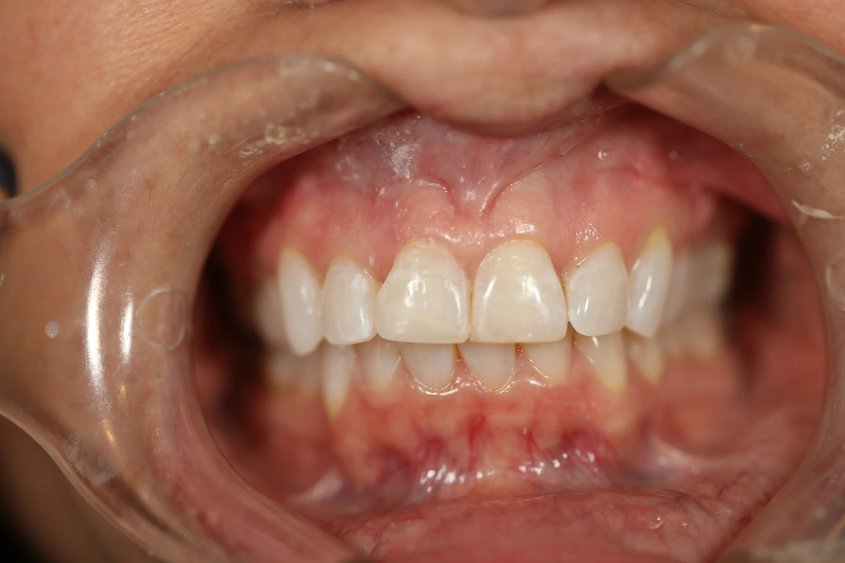 chipped tooth after