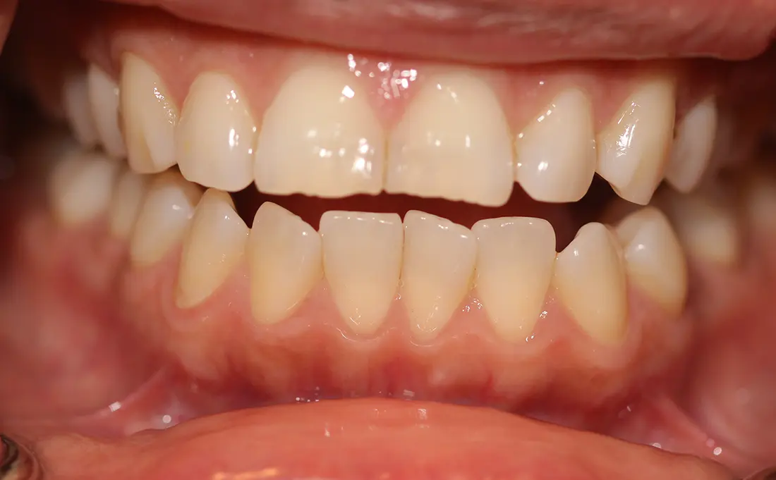 clear aligners and bonding before