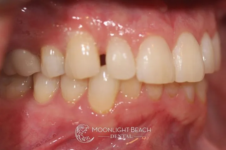 closing gaps between teeth after
