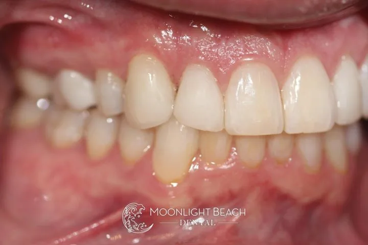 closing gaps between teeth before