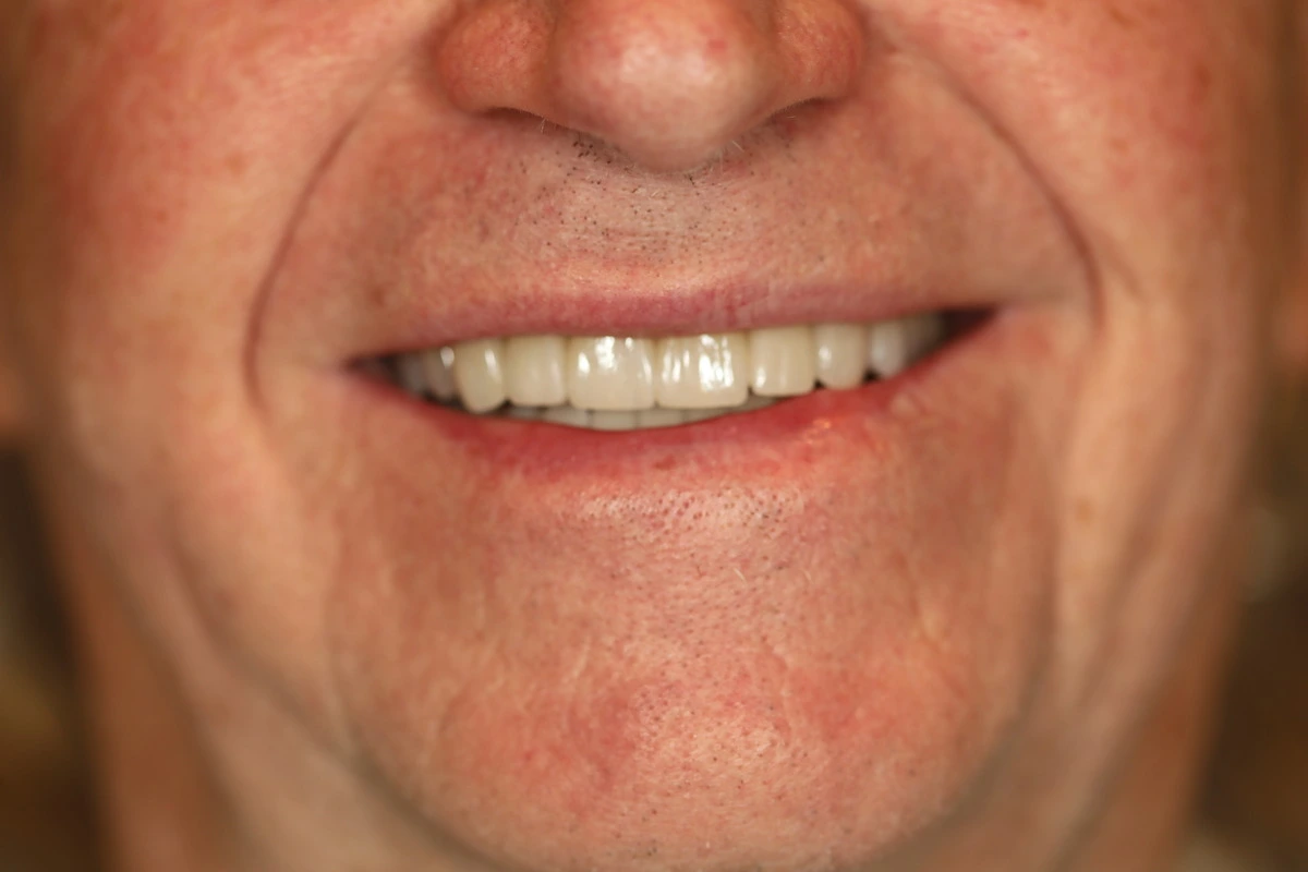 conservative porcelain after