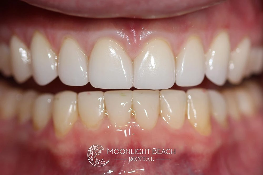 stunning natural result after conservative cosmetic smile makeover