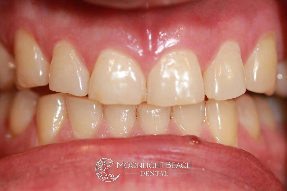 healthy teeth with minor imperfections before cosmetic smile makeover