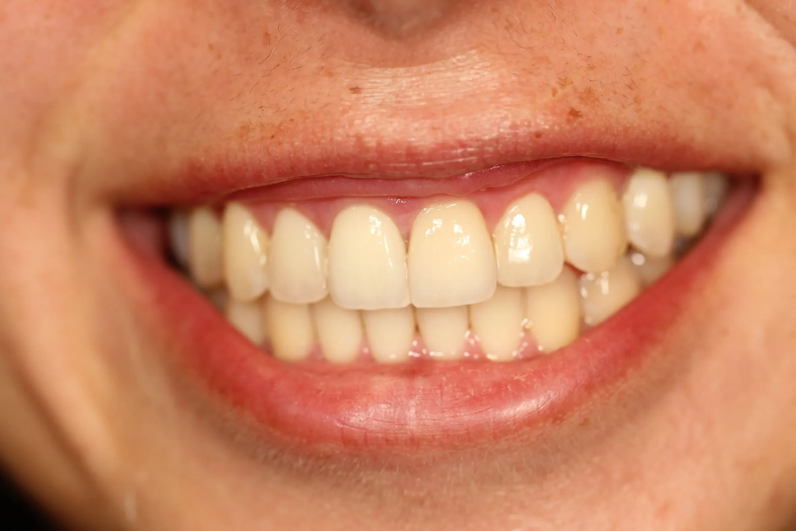 correction to dental veneers after