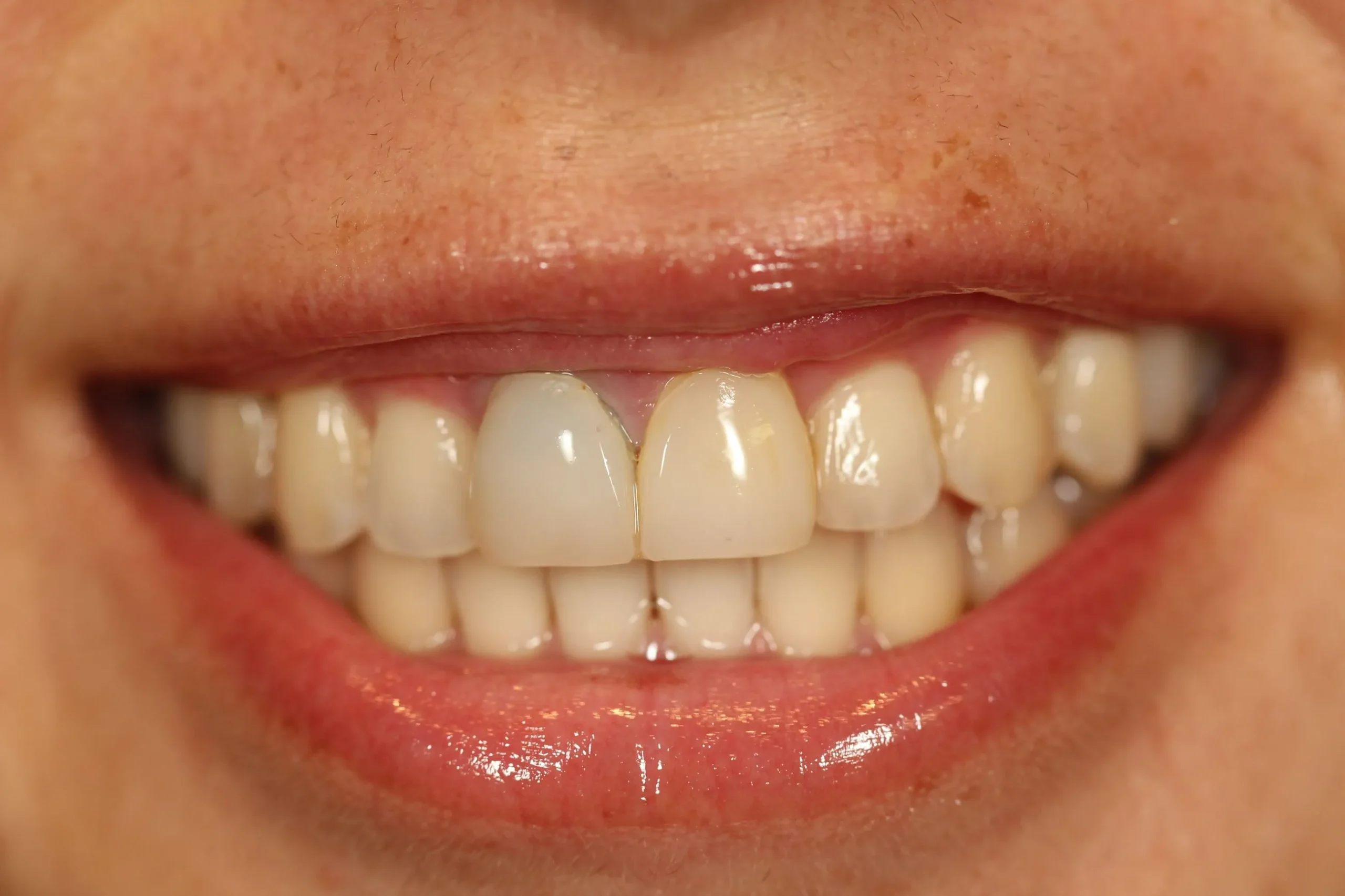 correction to dental veneers before