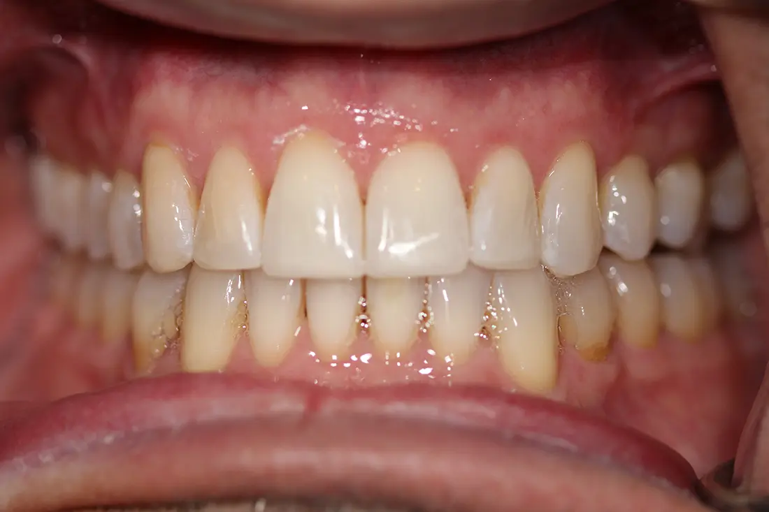 cosmetic bonding after