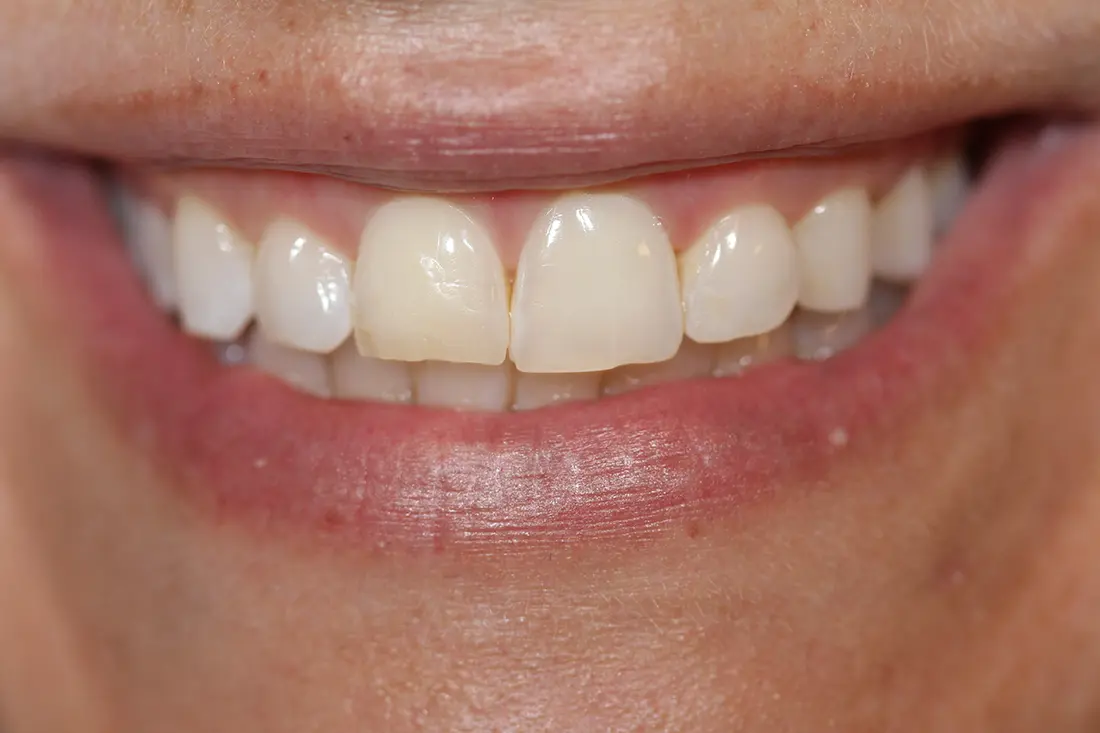 crown lengthening with laser therapy before