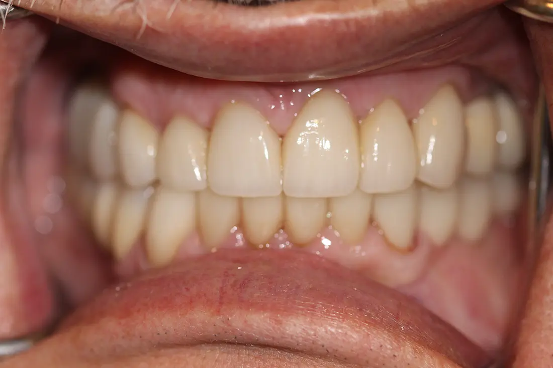 full mouth reconstruction after