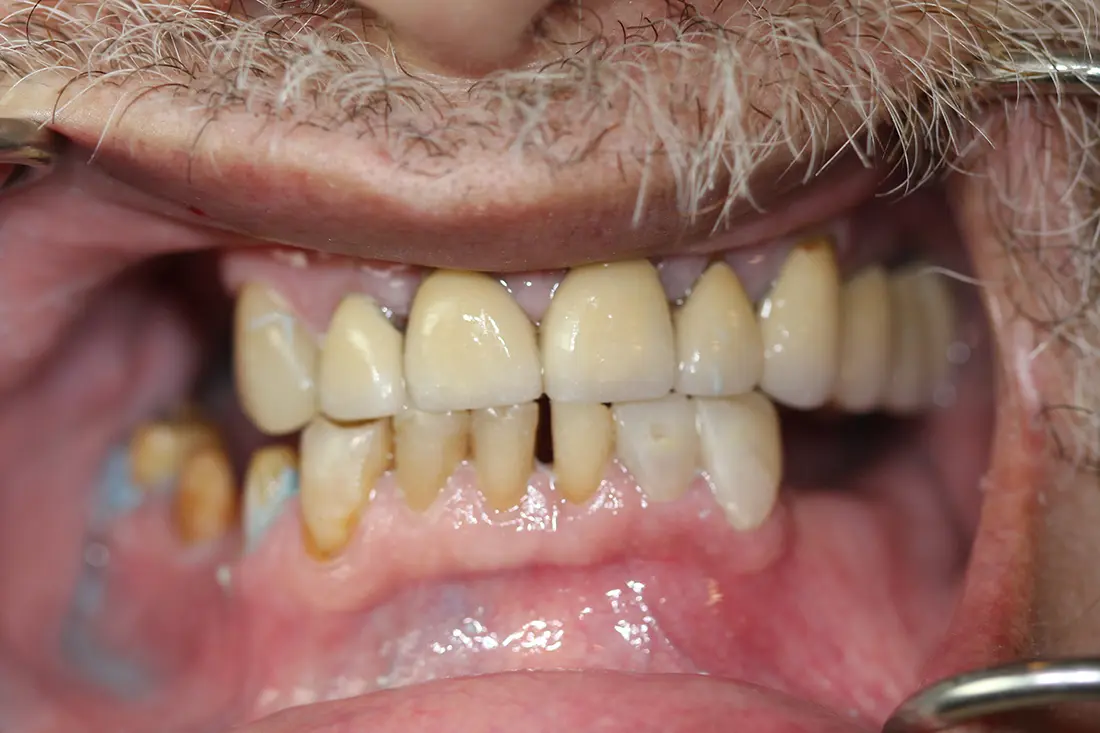 full mouth reconstruction before