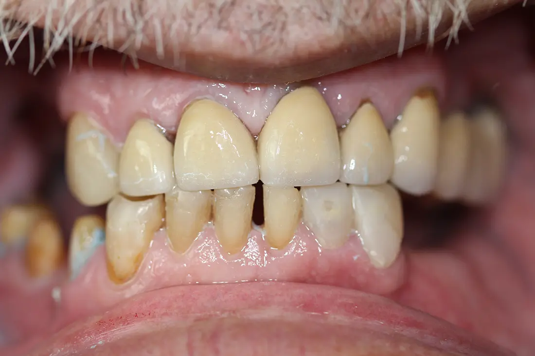 full mouth restoration before