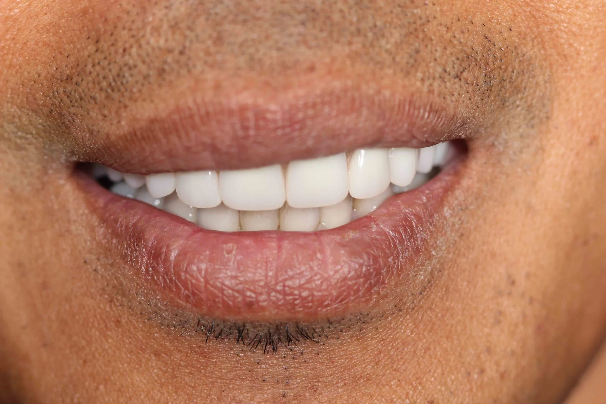 dental implants after