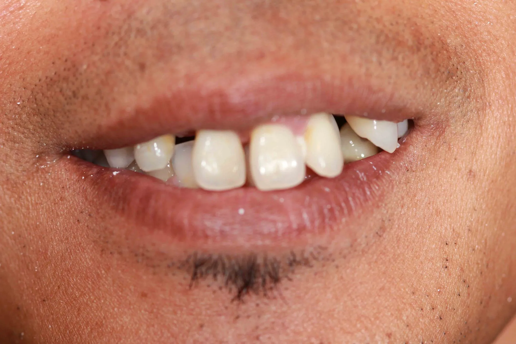 dental implants before