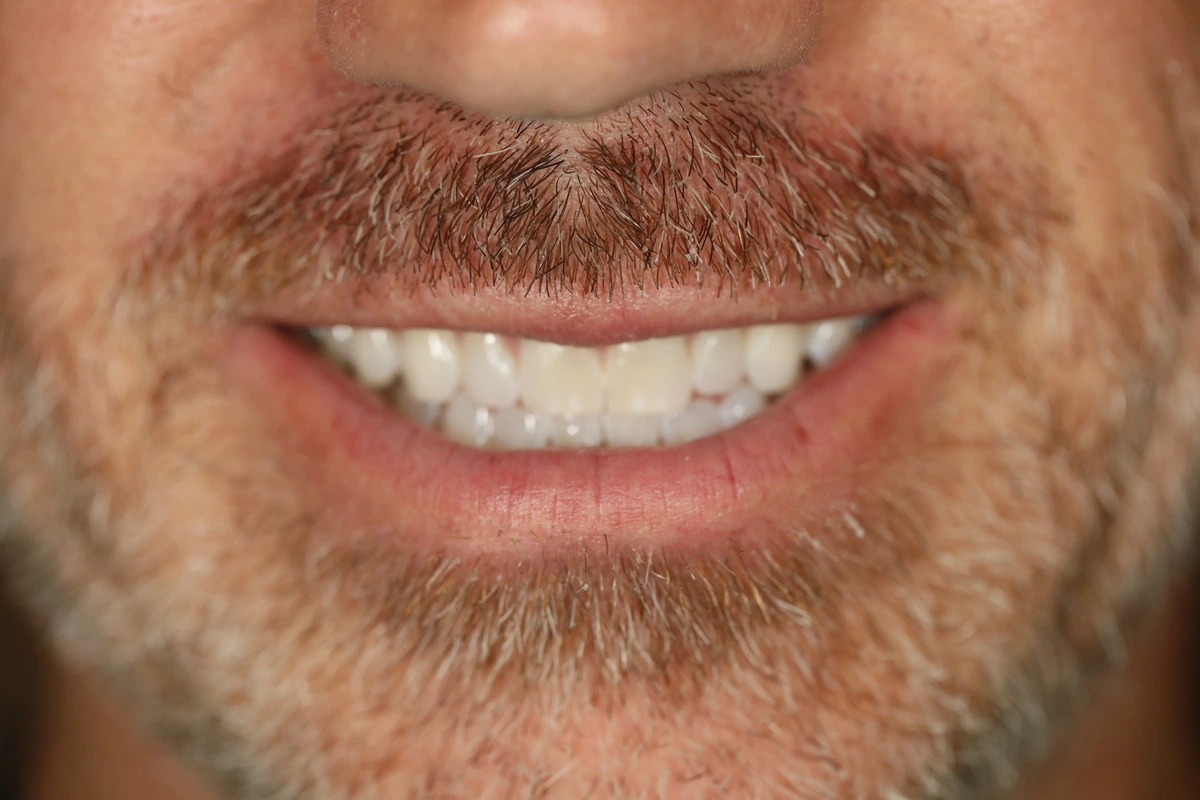 invisalign® transformation after