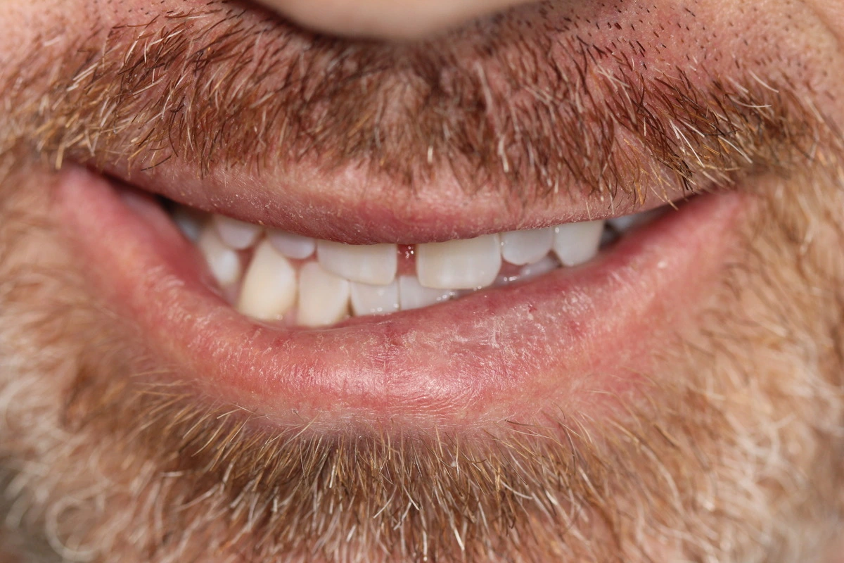 invisalign® transformation before
