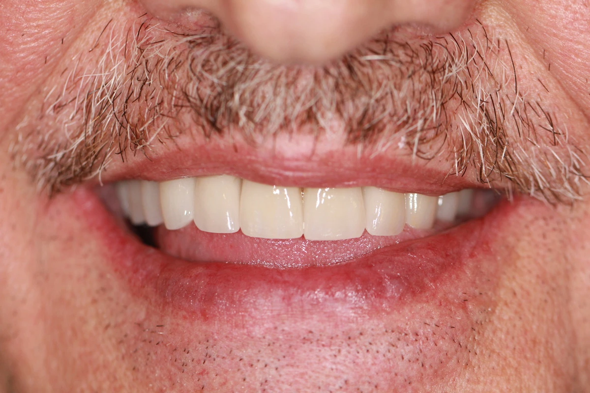 minimal prep crowns and bridges full mouth