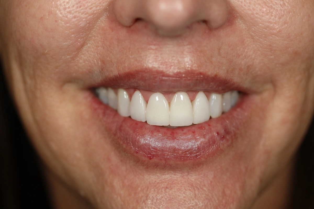 four minimal prep veneers and laser gum lift after results