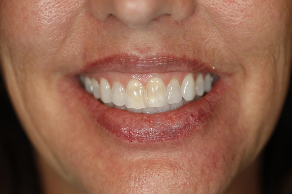 patient smile before minimal prep veneers and gum lift