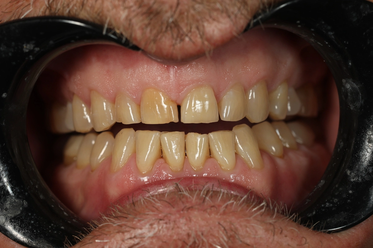minimal prep veneers before