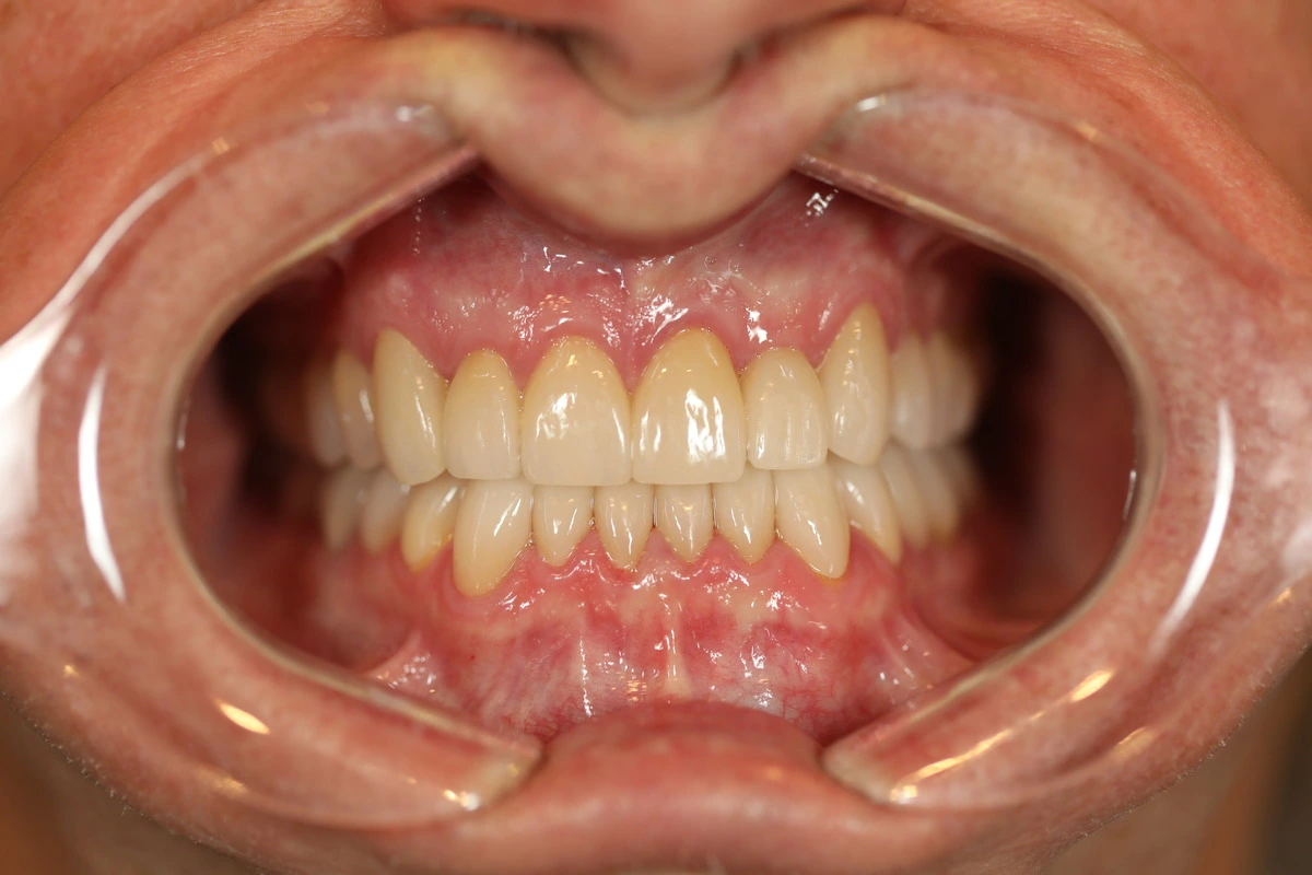 vibrant new smile after customized dental makeover treatment
