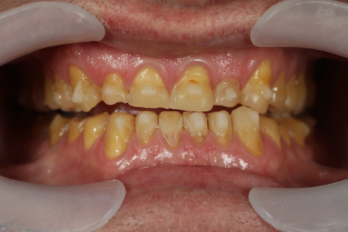 patient teeth and smile alignment before makeover