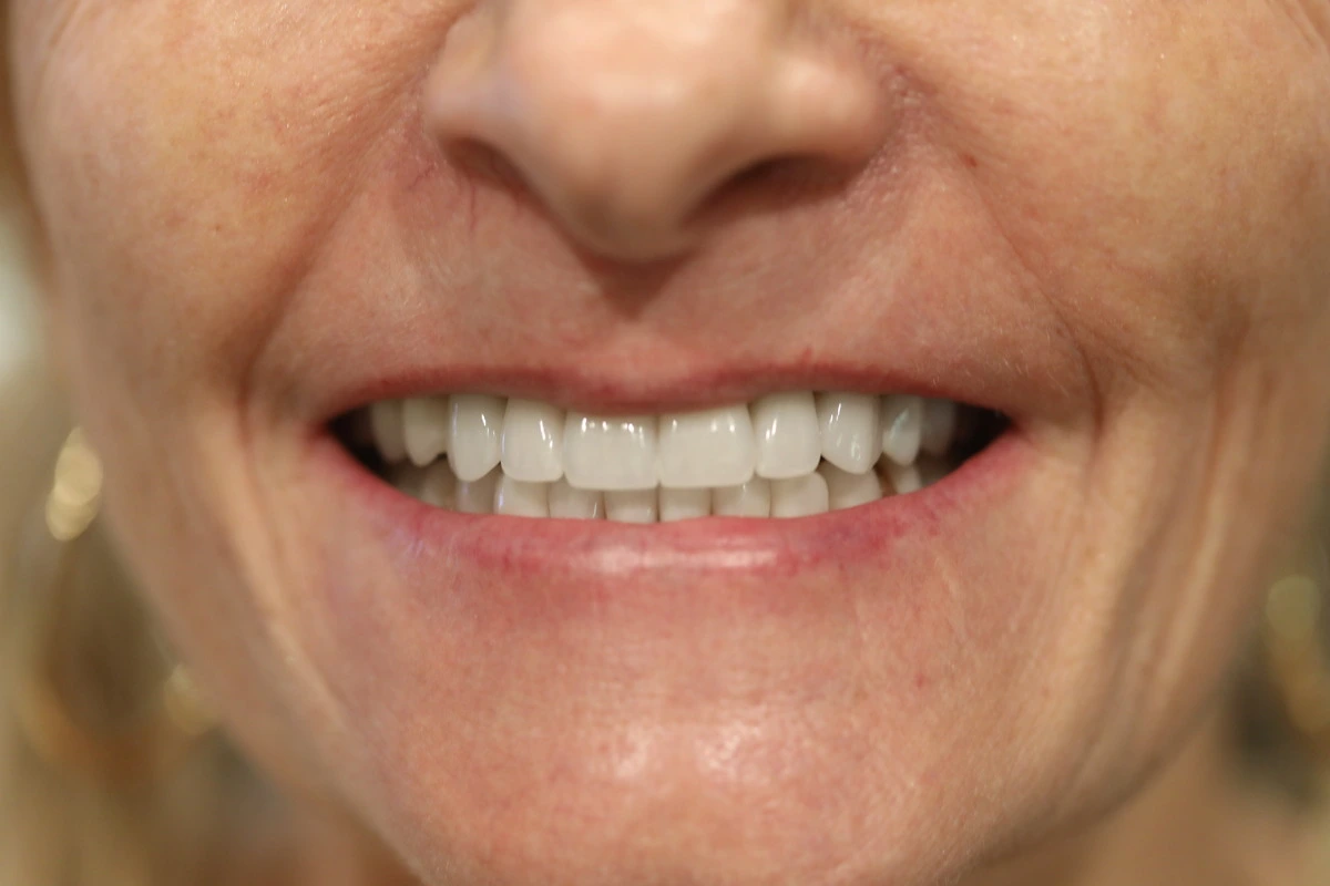 porcelain veneer replacement after