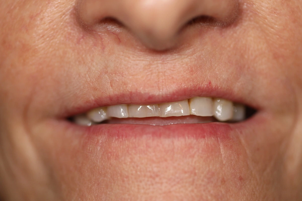stained short teeth before porcelain veneers transformation