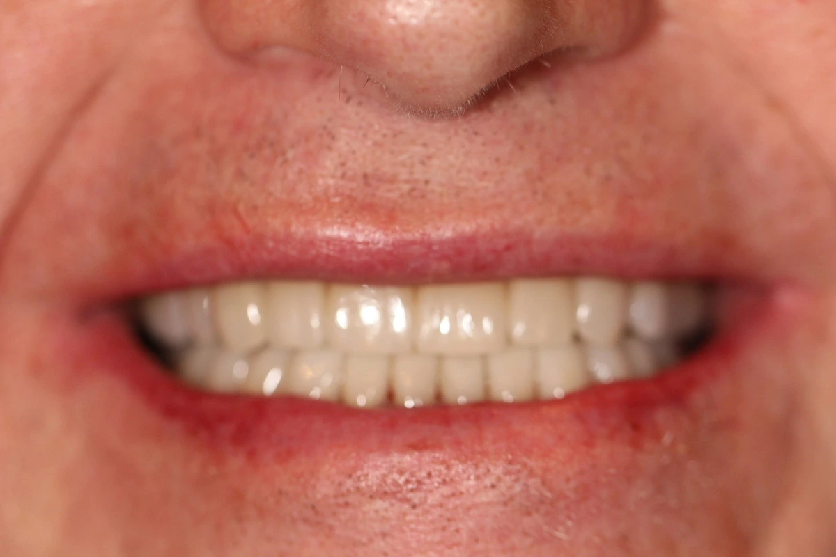 rebuilding a smile after