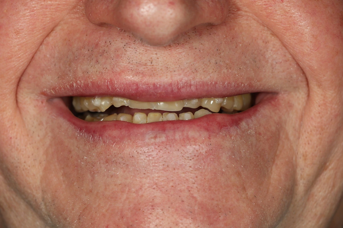 rebuilding a smile before