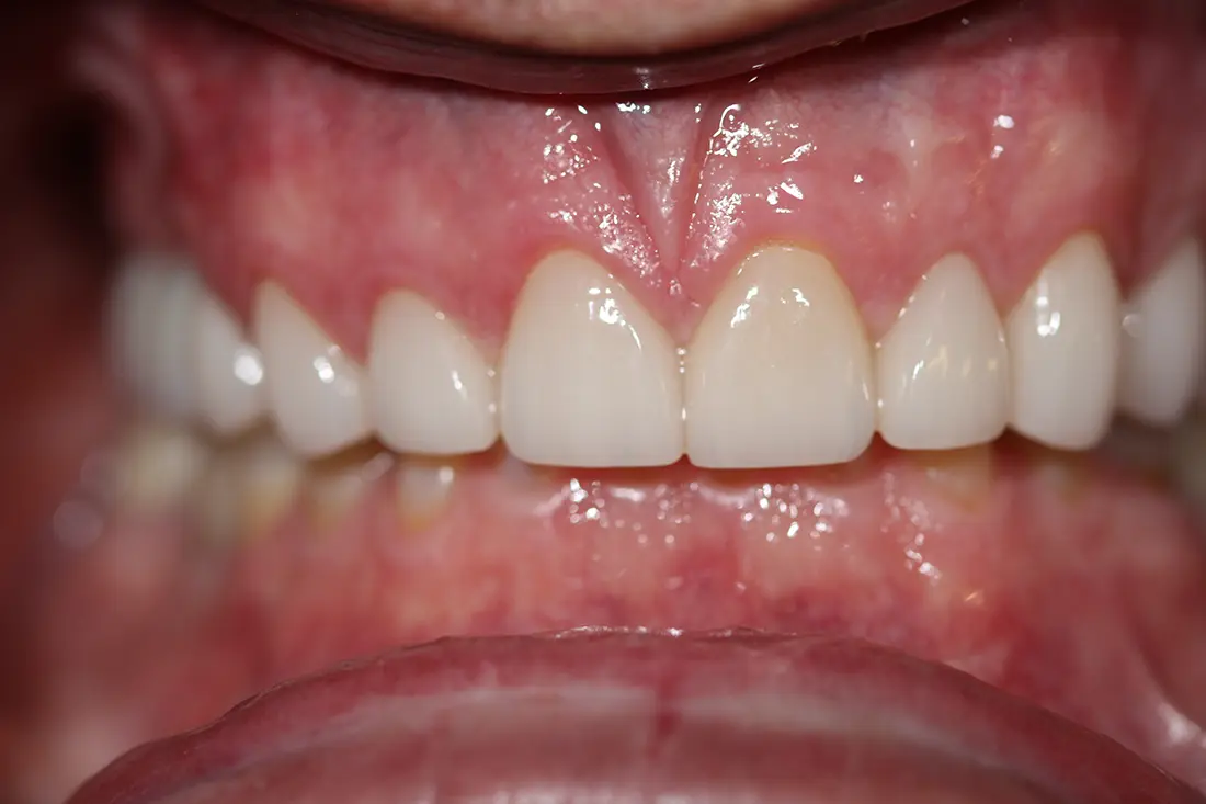renewing the size and look of teeth after