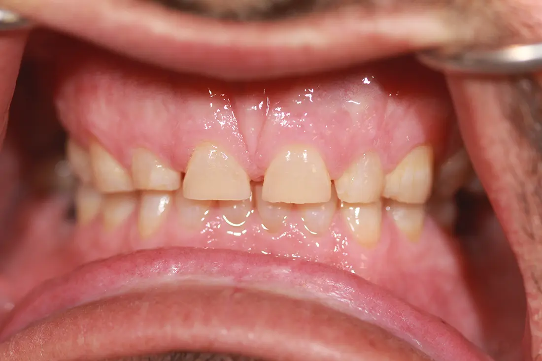 renewing the size and look of teeth before