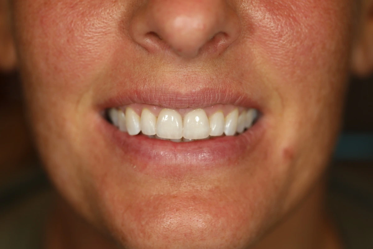 replacing old bonding after