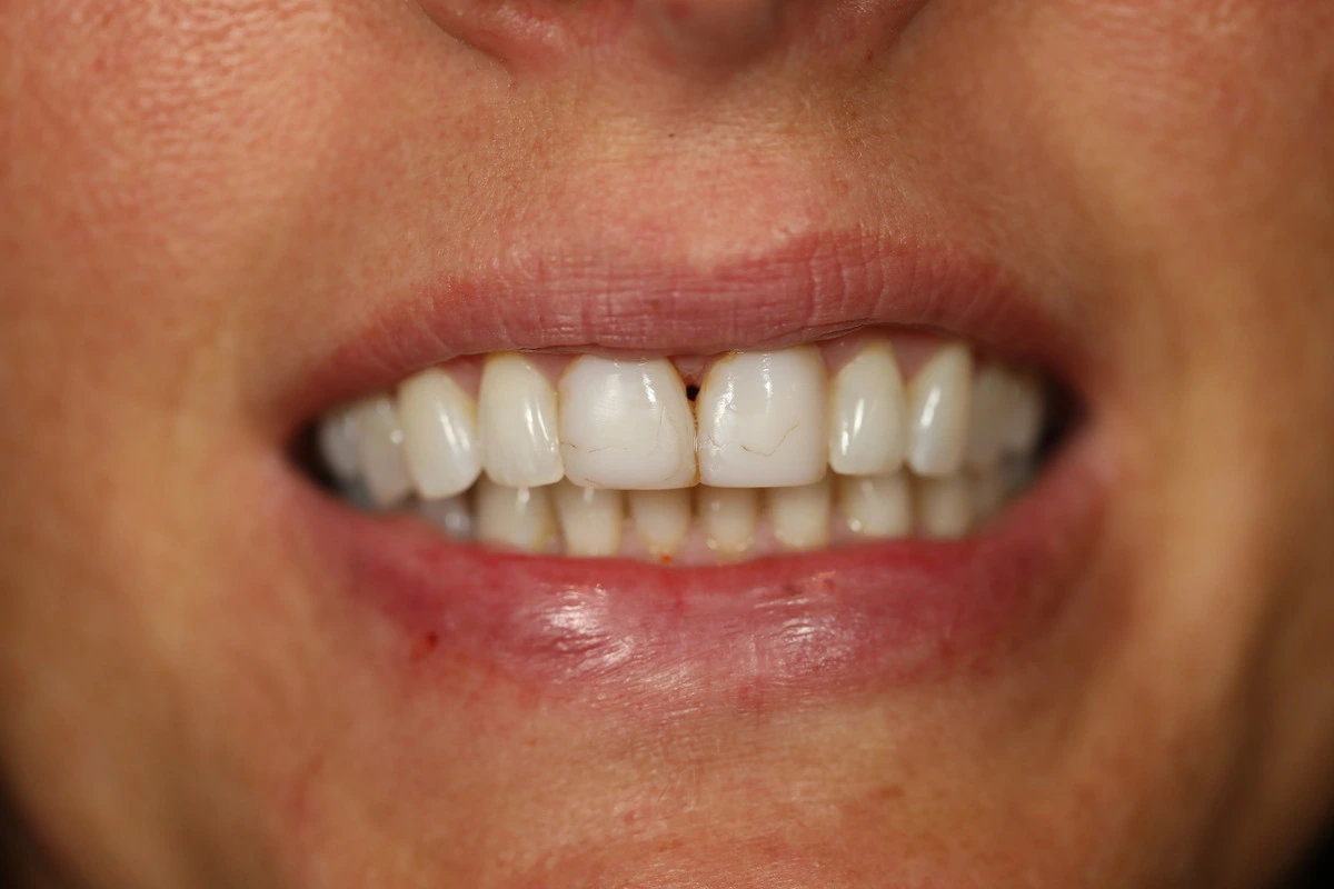 replacing old bonding before
