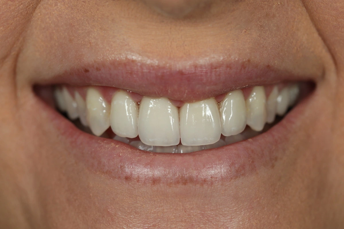 replacing old dentistry after