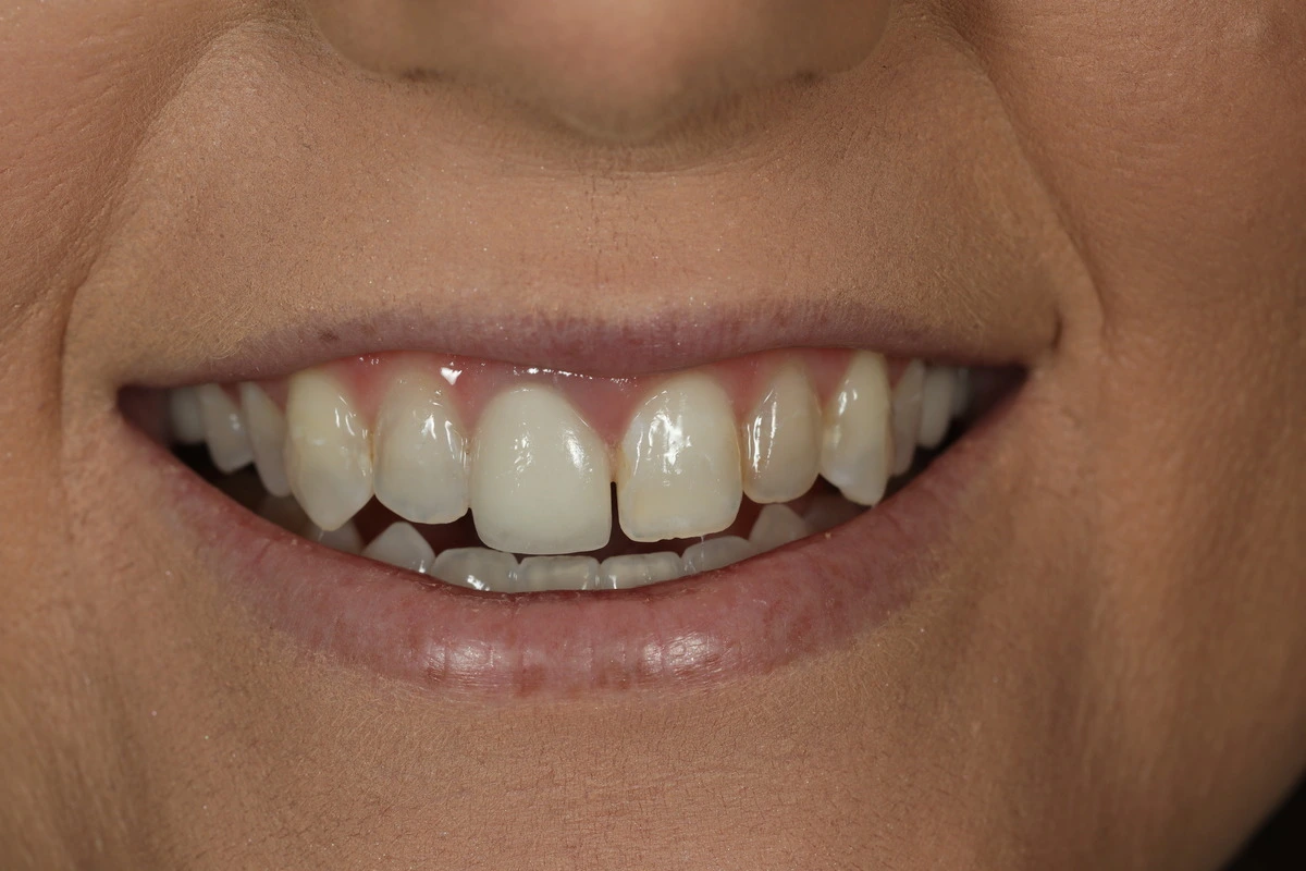 replacing old dentistry before