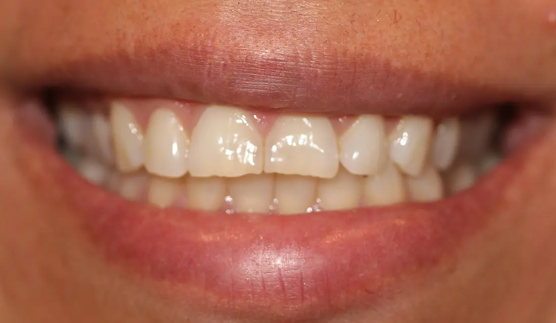 reviving worn teeth before