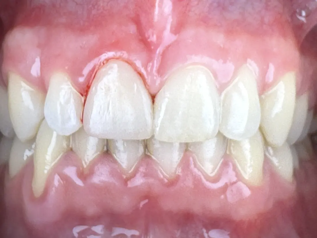 same-day crown after