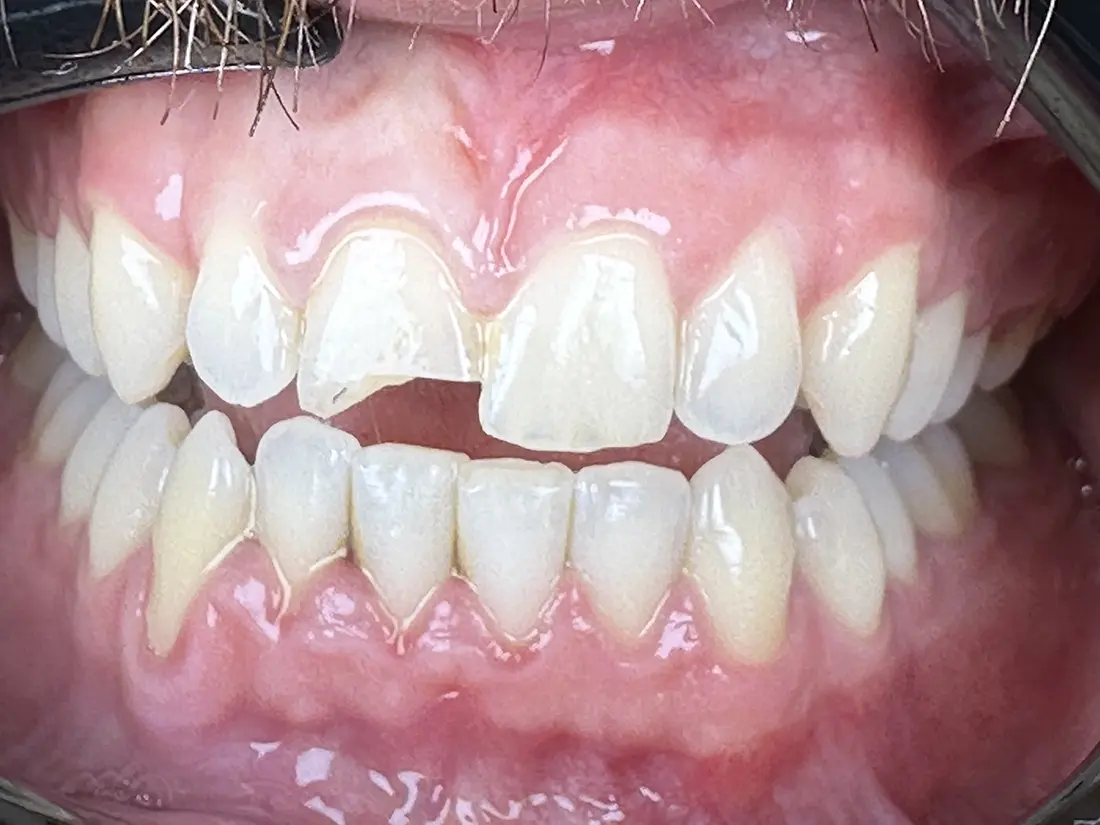same-day crown before