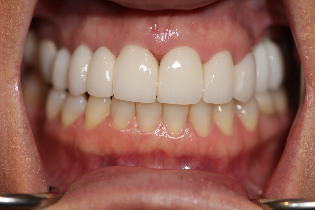 smile improvement after