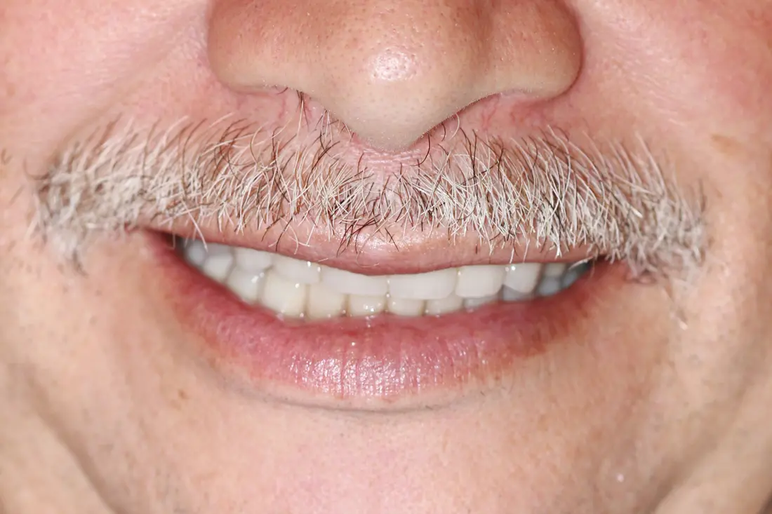 smile restoration after